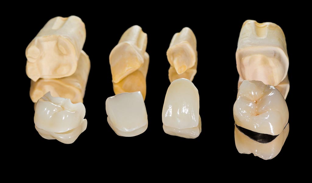 Varianten von Zahn-Kronen