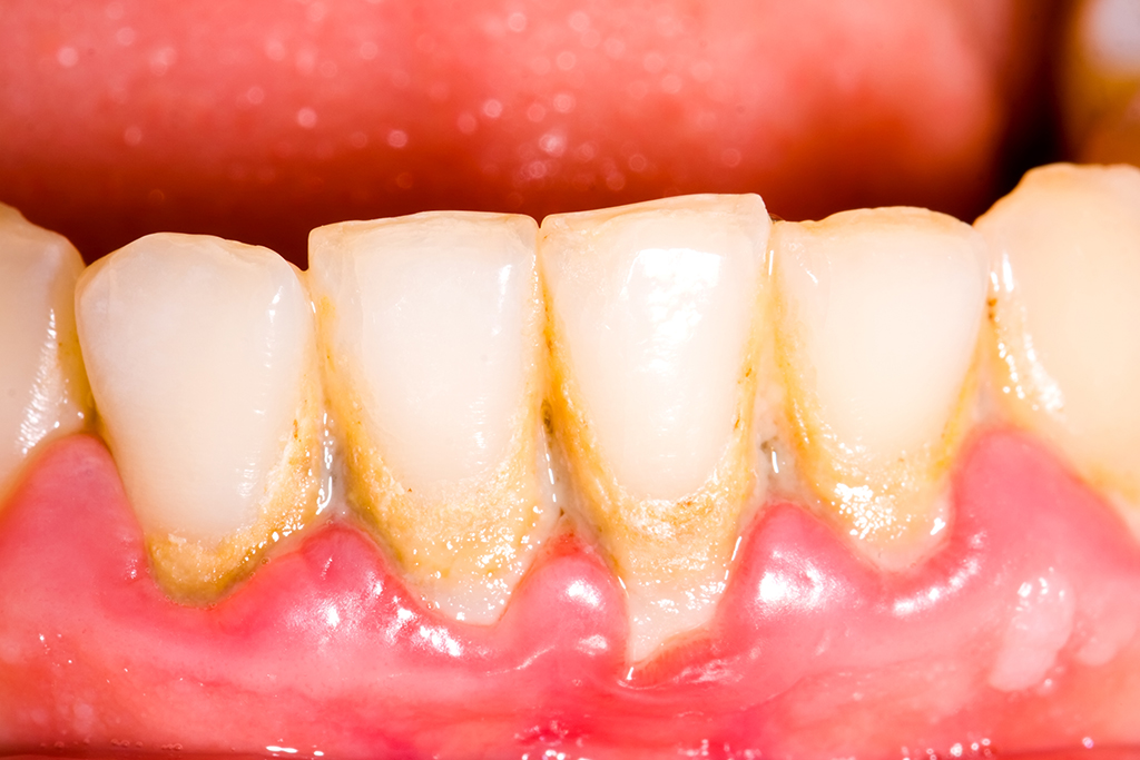 Zahnstein die Vorstufe der Parodontose